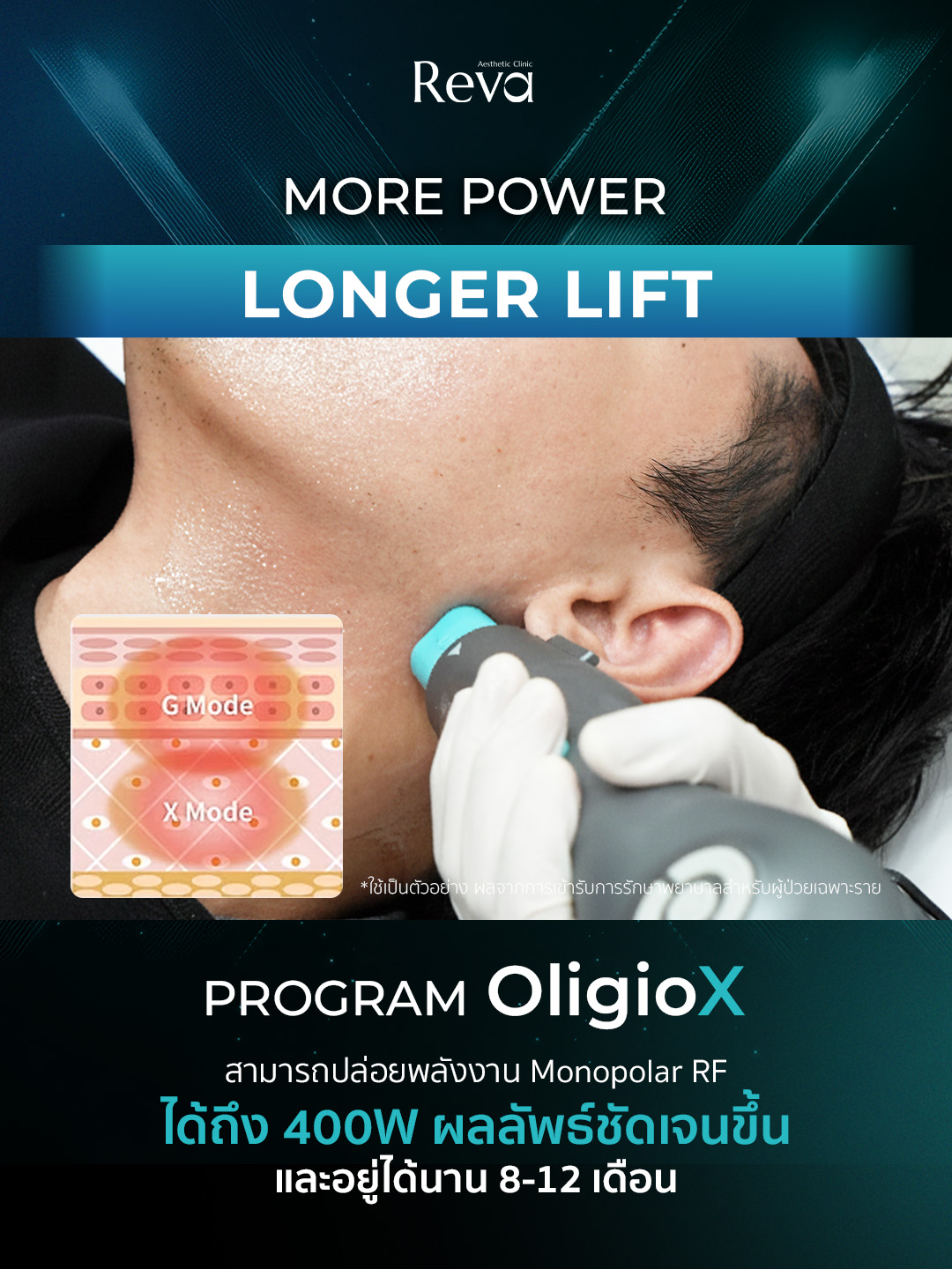 Oligio X Device