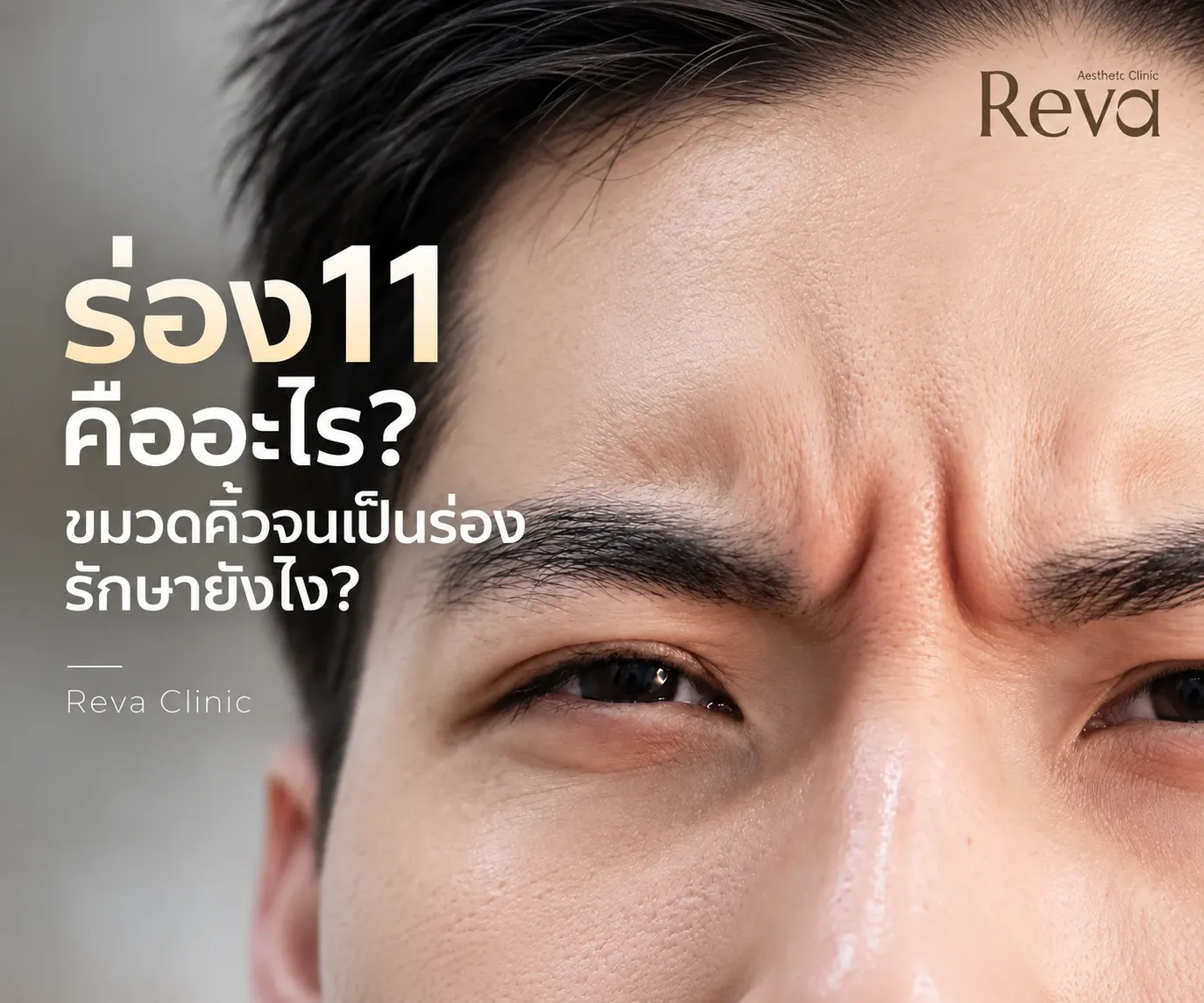 ร่อง 11 ขมวดคิ้วจนเป็นร่อง