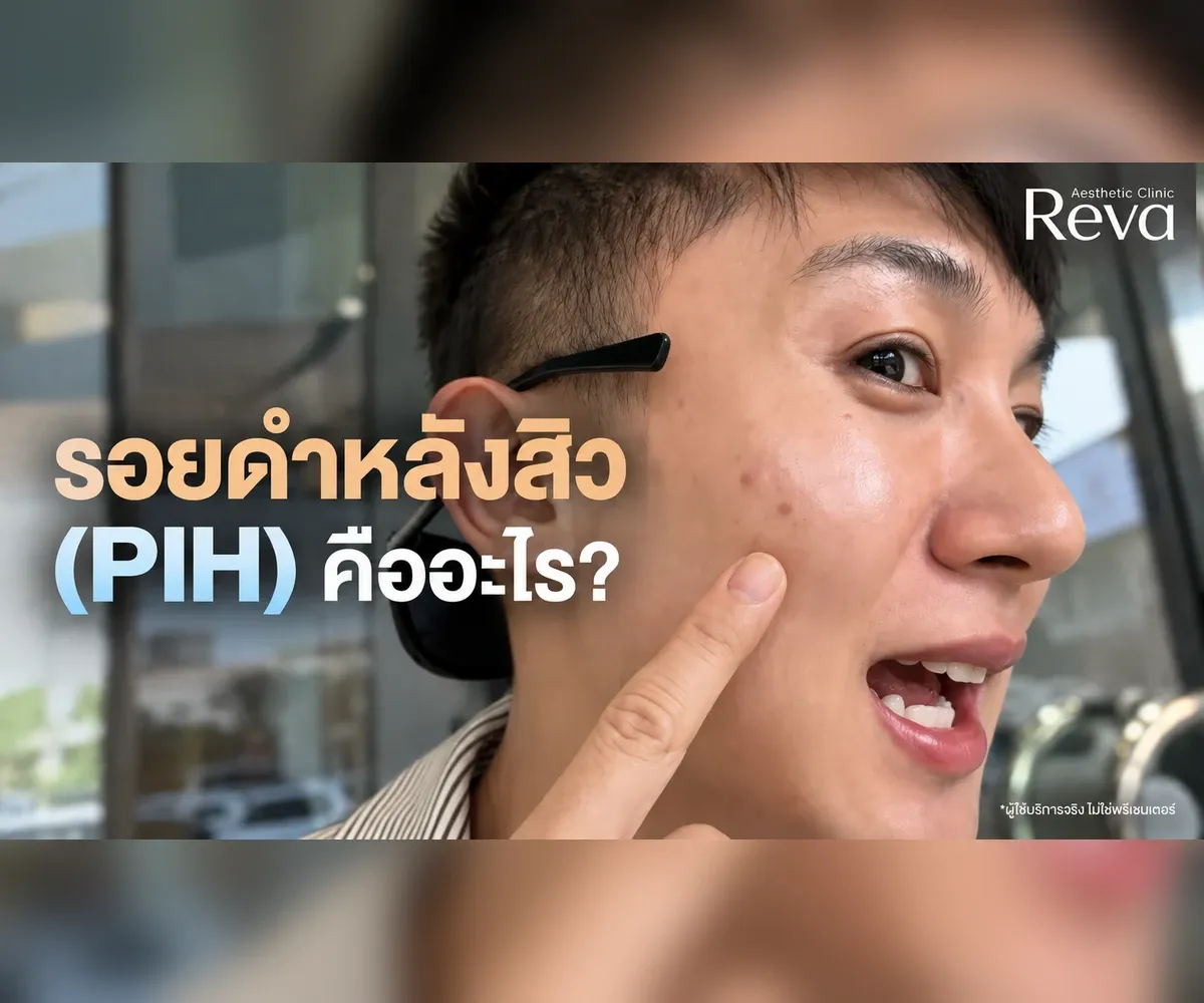 รอยดำหลังสิว