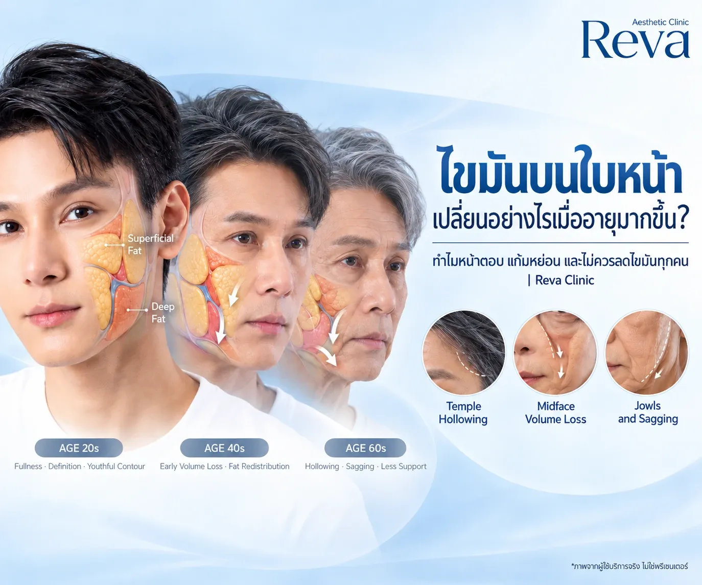 ไขมันบนใบหน้าเปลี่ยนอย่างไรเมื่ออายุมากขึ้น?