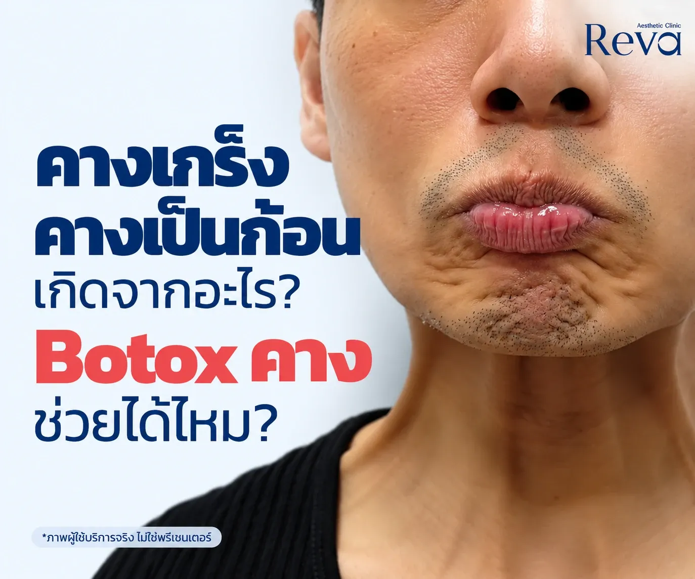 คางเกร็ง คางเป็นก้อน เกิดจากอะไร? Botox คางช่วยได้ไหม | Reva Clinic