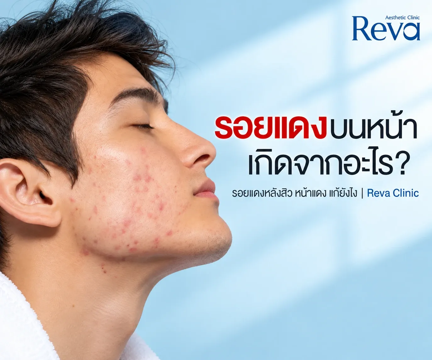 รอยแดง
