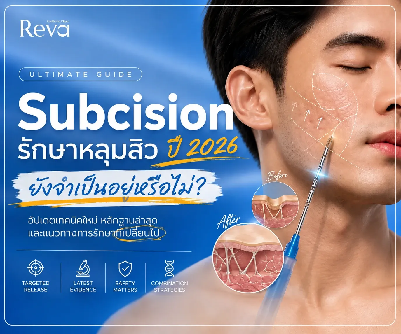 Subcision รักษาหลุมสิว ปี 2026 ยังจำเป็นอยู่ไหม? อัปเดตเทคนิคใหม่และหลักฐานล่าสุด