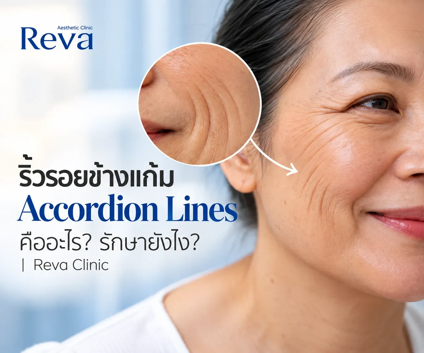 What Are Accordion Lines?