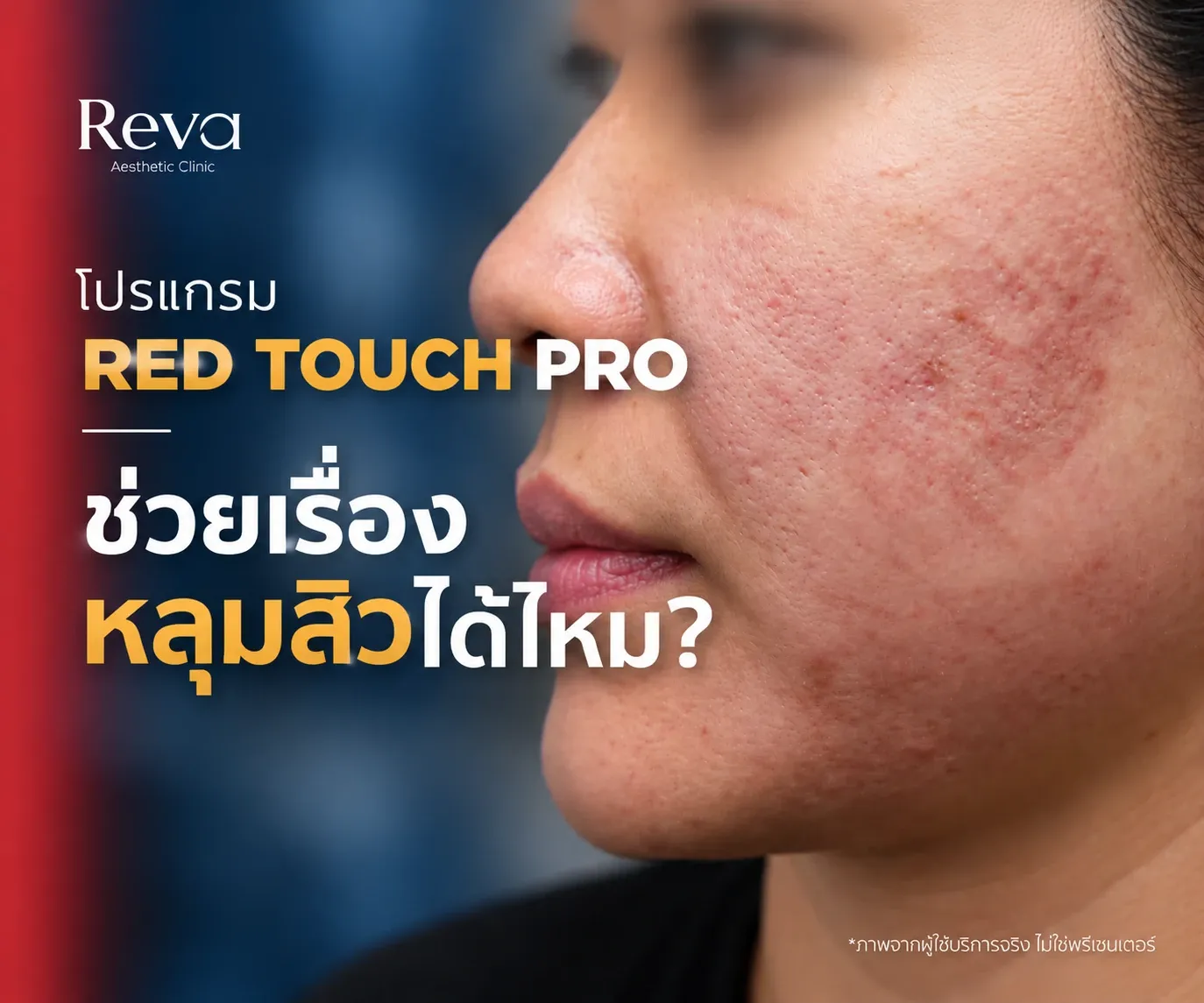 RedTouch Pro ช่วยเรื่องหลุมสิวได้ไหม