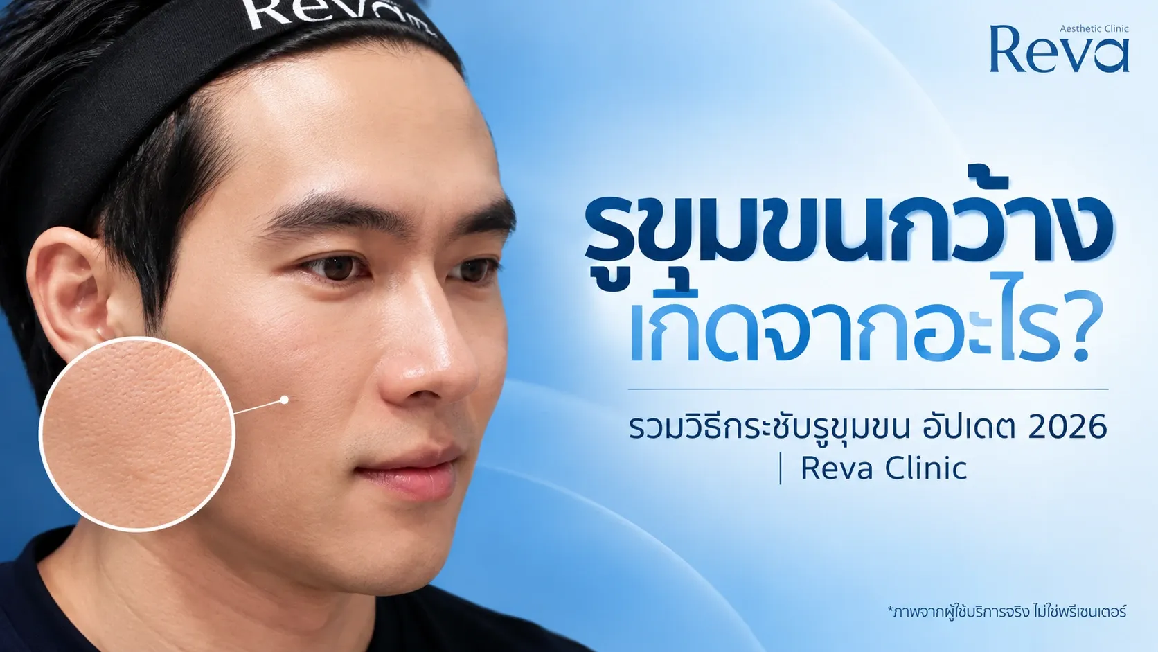 รูขุมขนกว้าง