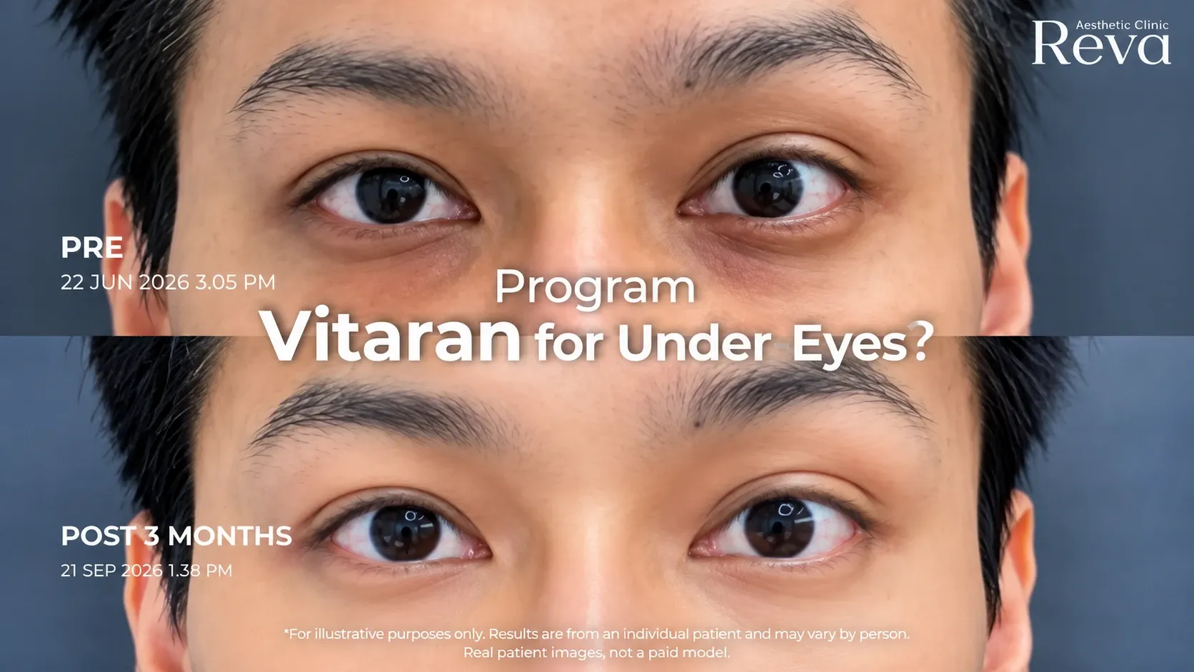 Vitaran ใต้ตาดีไหม