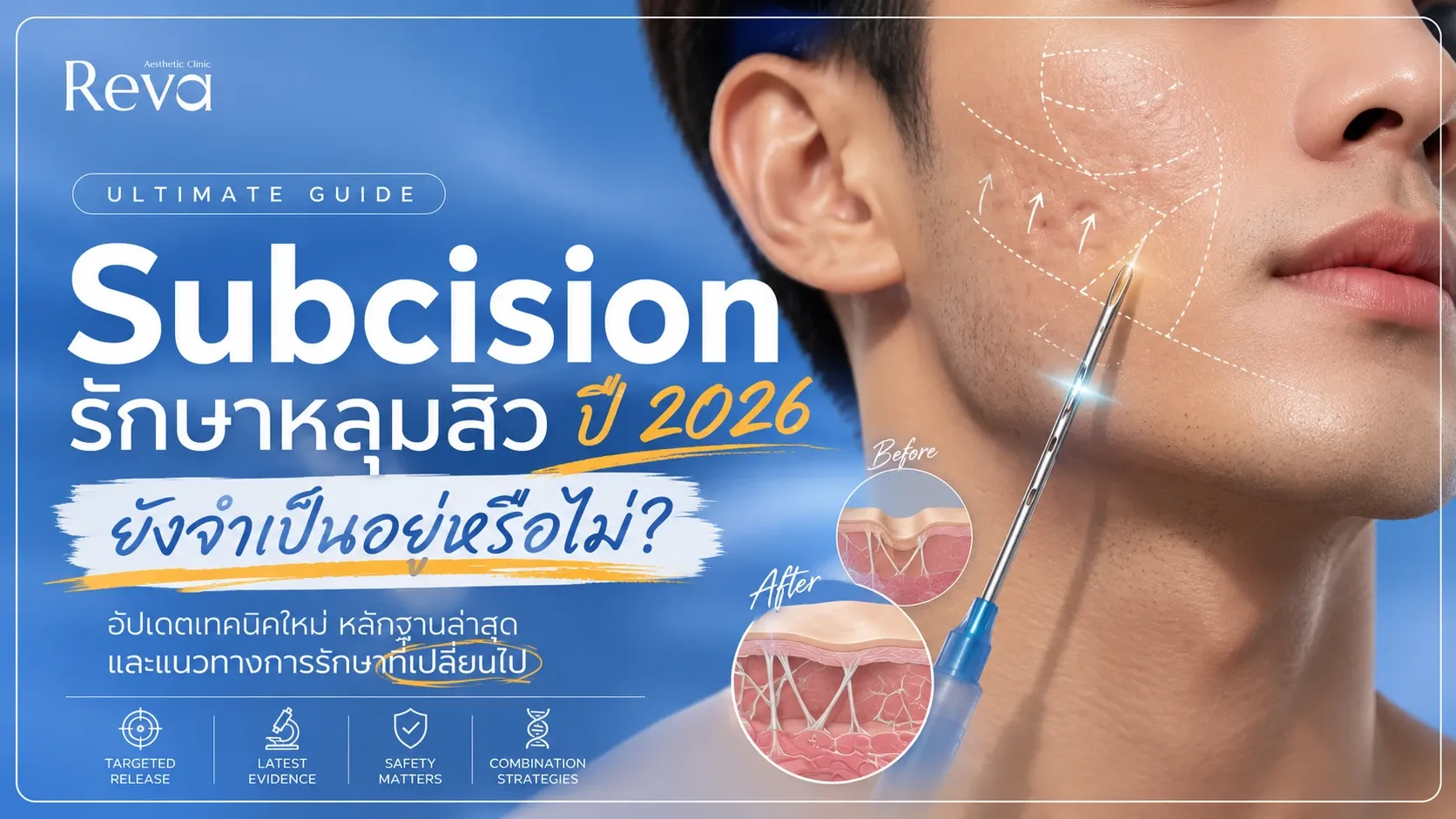 subcision acne scar