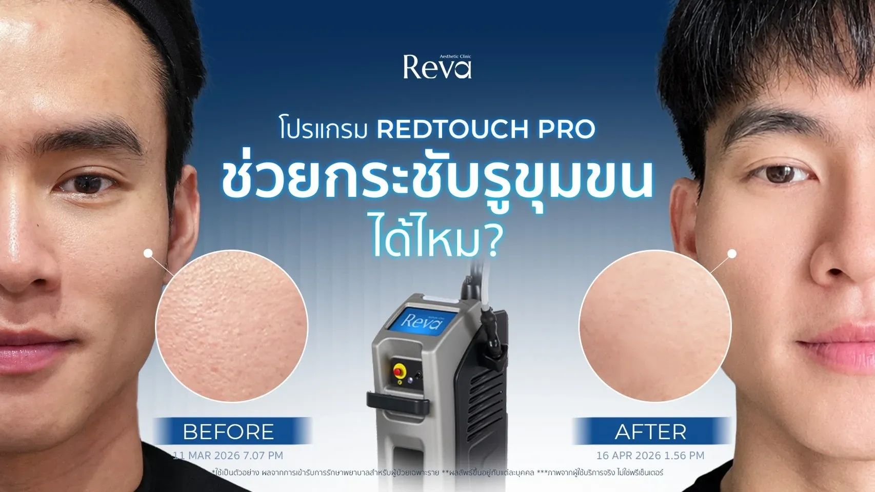 โปรแกรม RedTouch Pro ช่วยกระชับรูขุมขนได้ไหม?