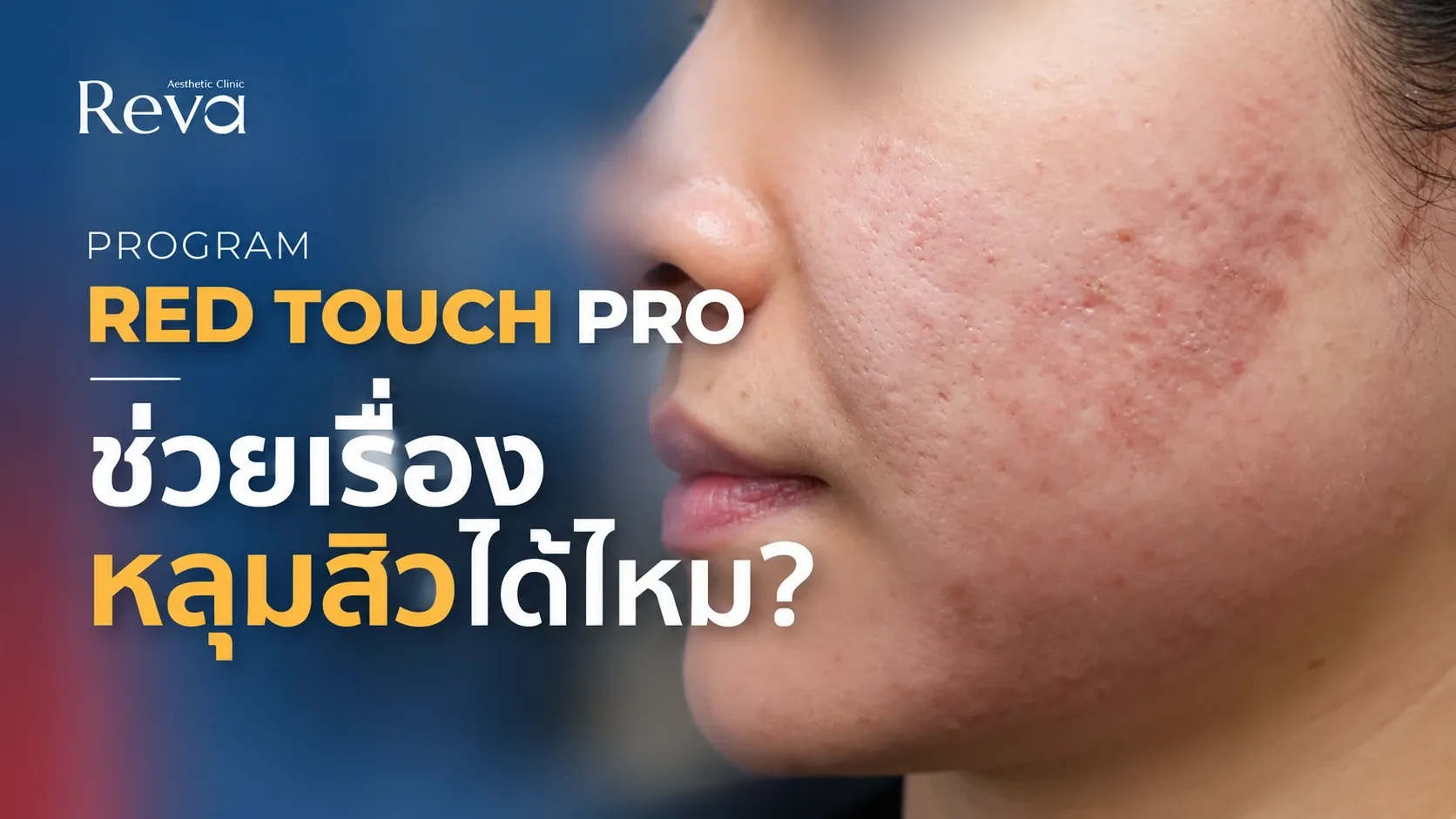 RedTouch Pro ช่วยเรื่องหลุมสิวได้ไหม