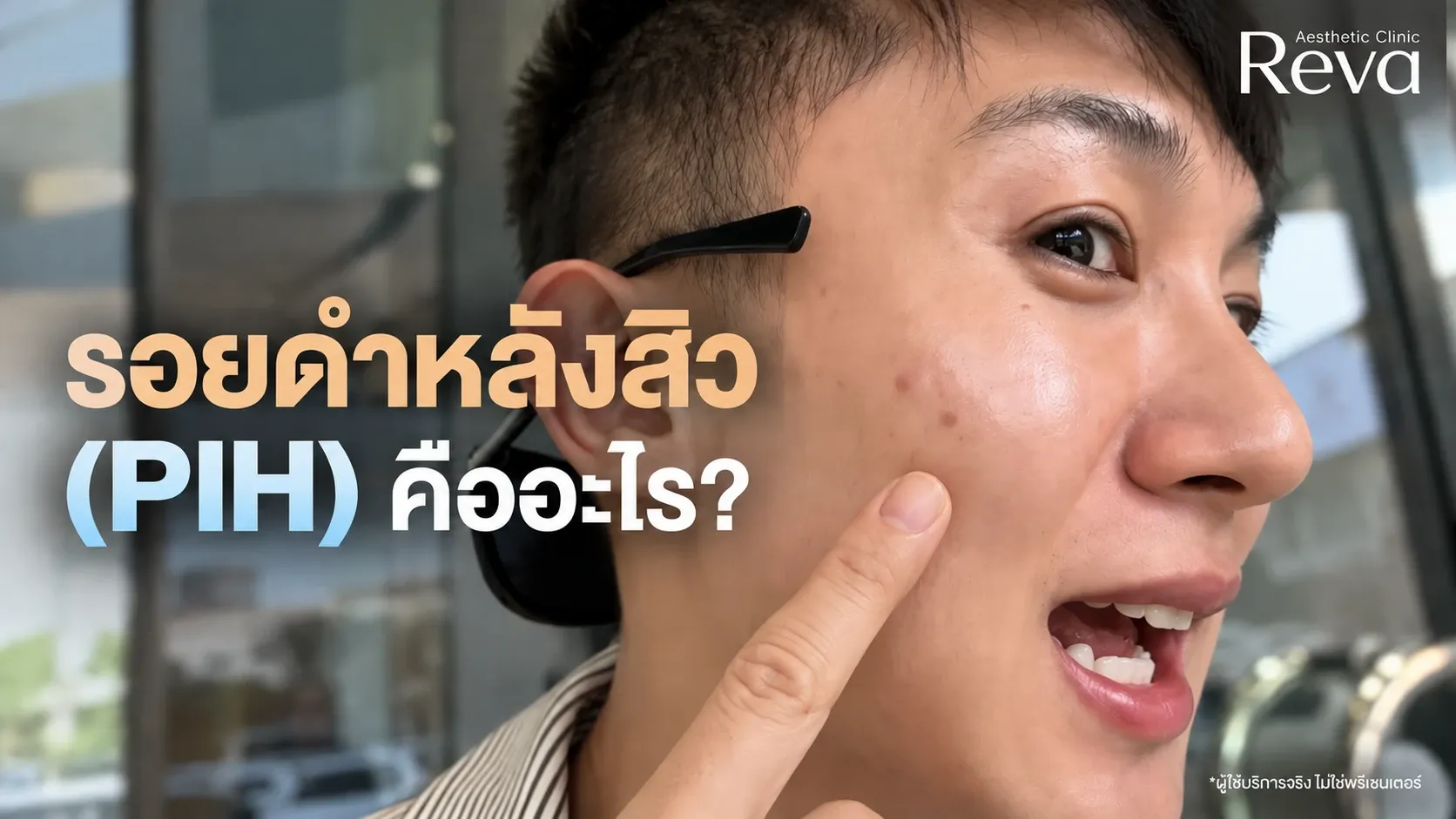 รอยดำหลังสิว