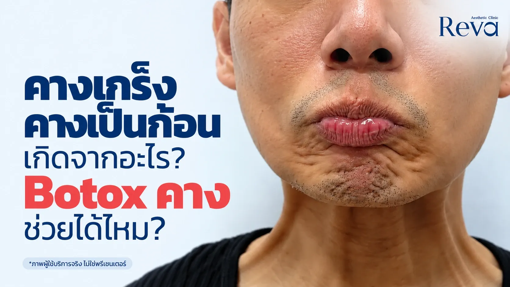 คางเกร็ง คางเป็นก้อน เกิดจากอะไร? Botox คางช่วยได้ไหม | Reva Clinic