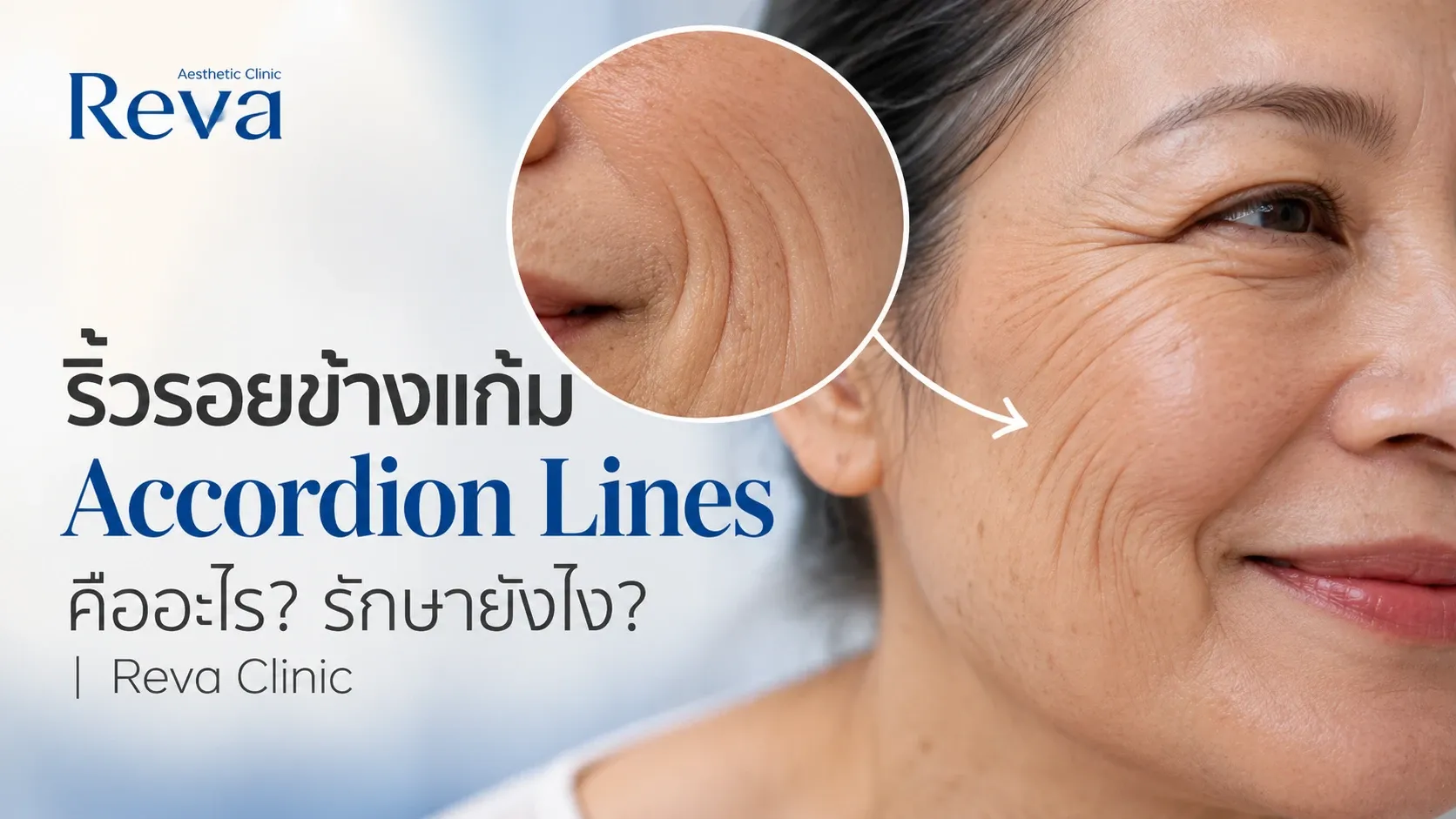 Accordion Lines คืออะไร?