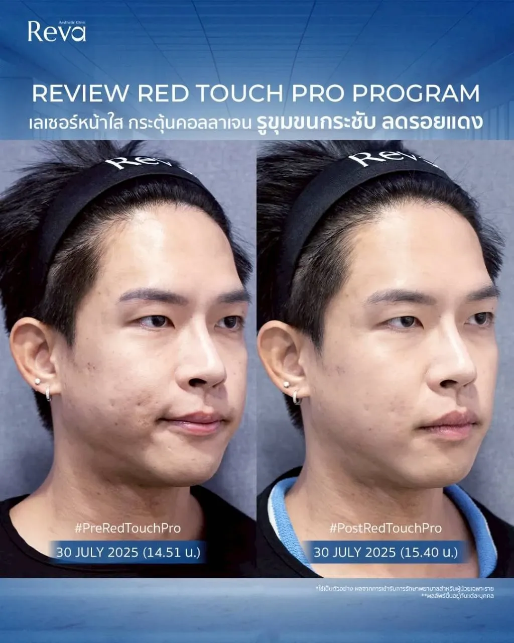 รีวิว Red touch pro
