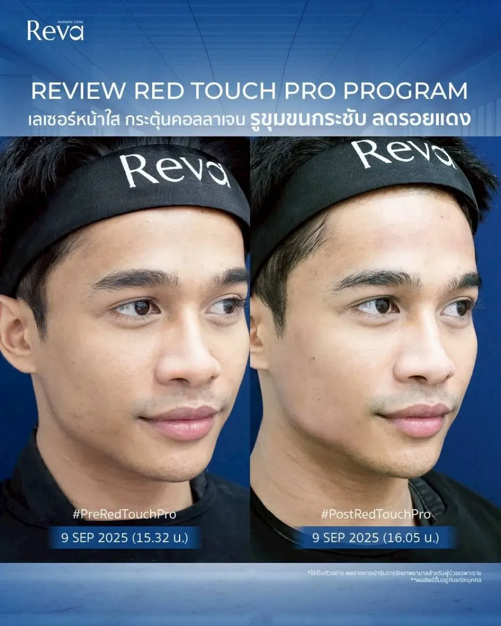 รีวิว Red touch pro