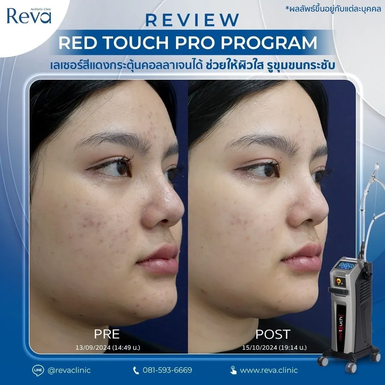 รีวิว red touch