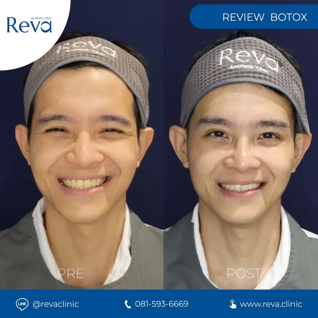 รีวิว xeomin
