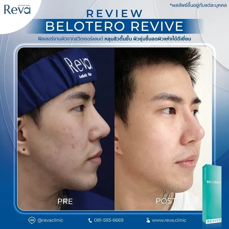 รีวิว Revive