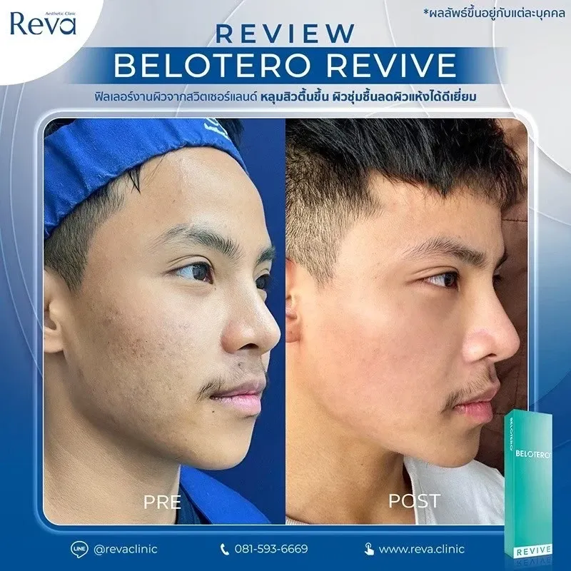 รีวิว Revive