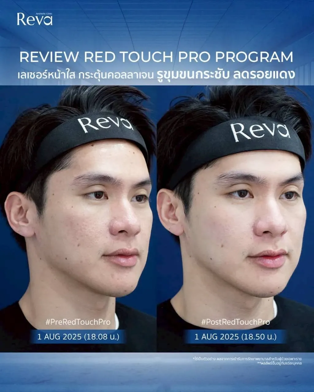 รีวิว Red touch pro