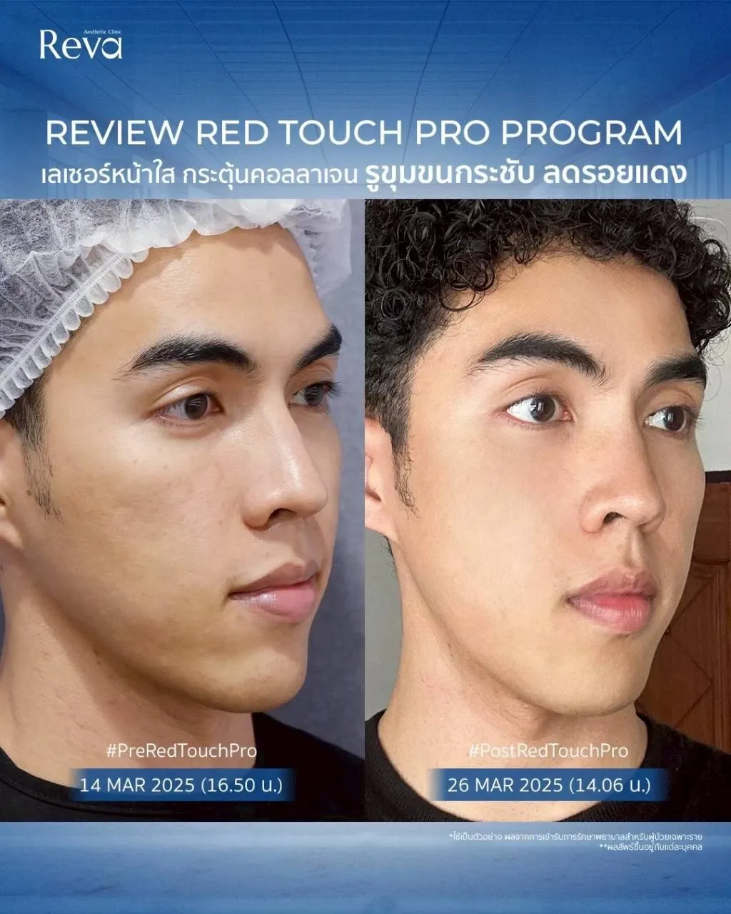 รีวิว Red touch pro