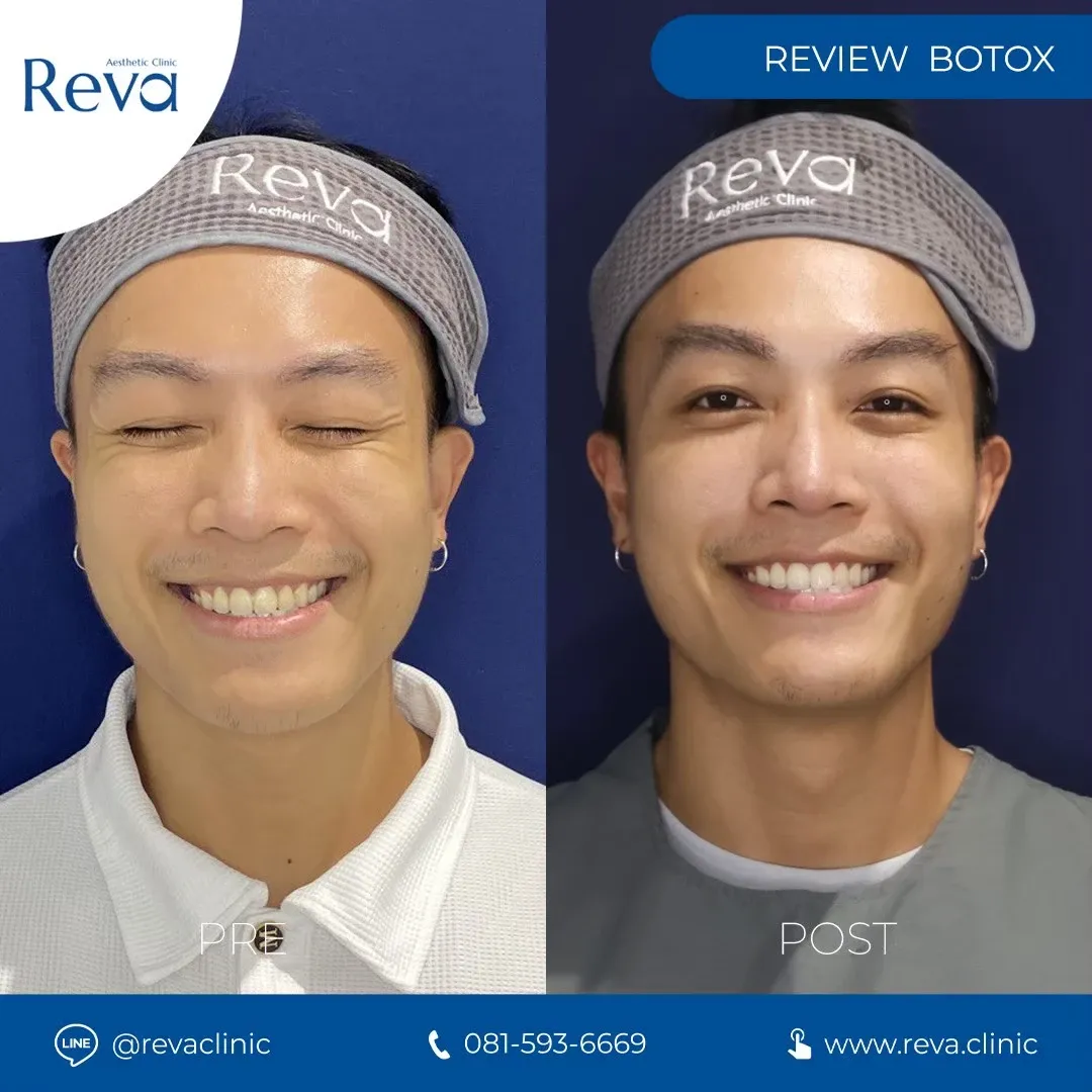 รีวิว xeomin