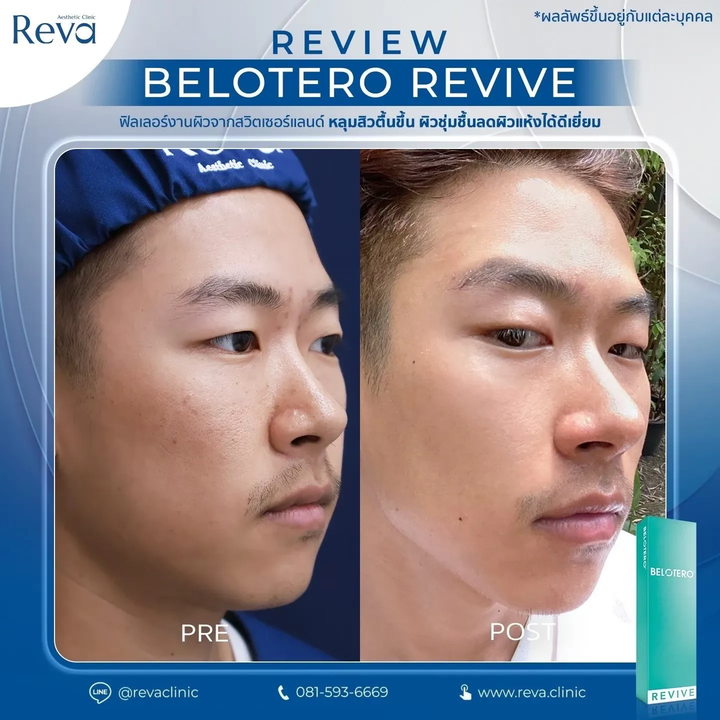 รีวิว Revive