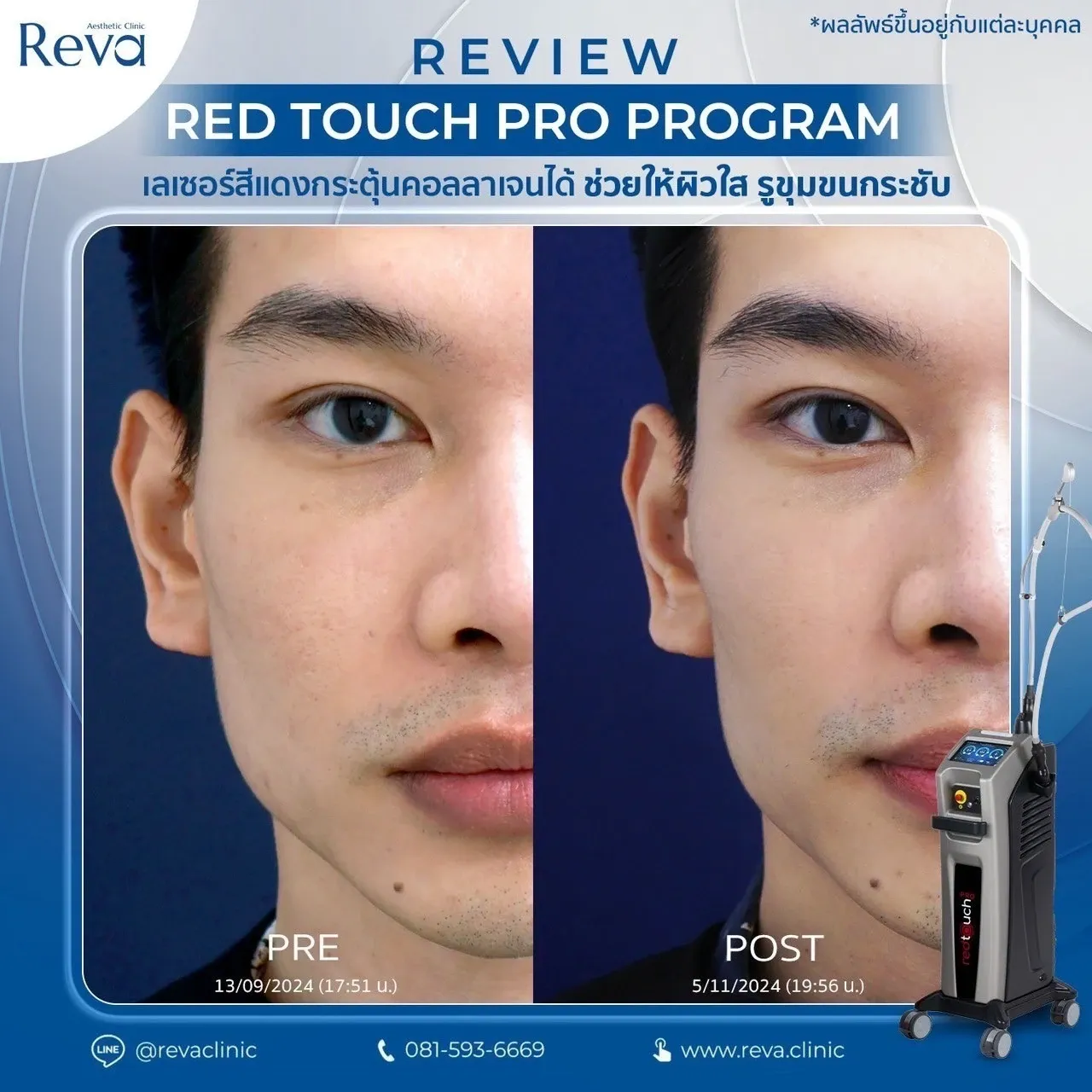 รีวิว red touch