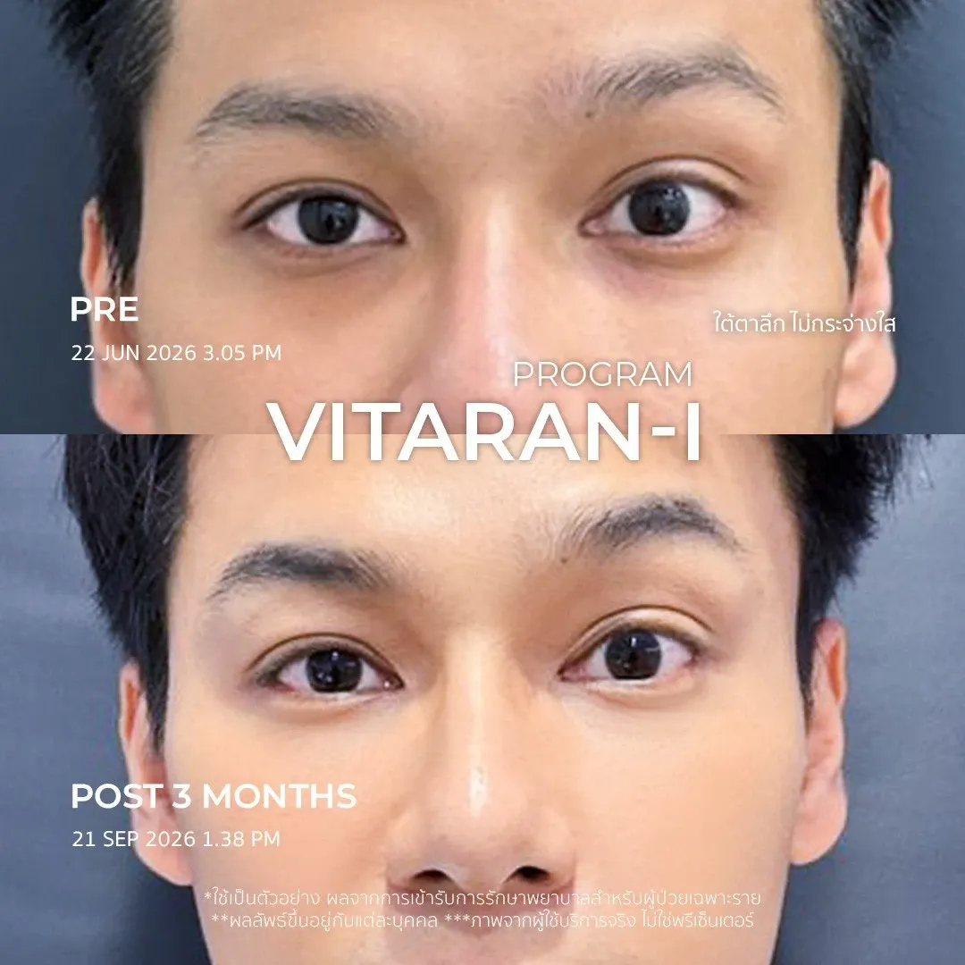 รีวิว vitaran