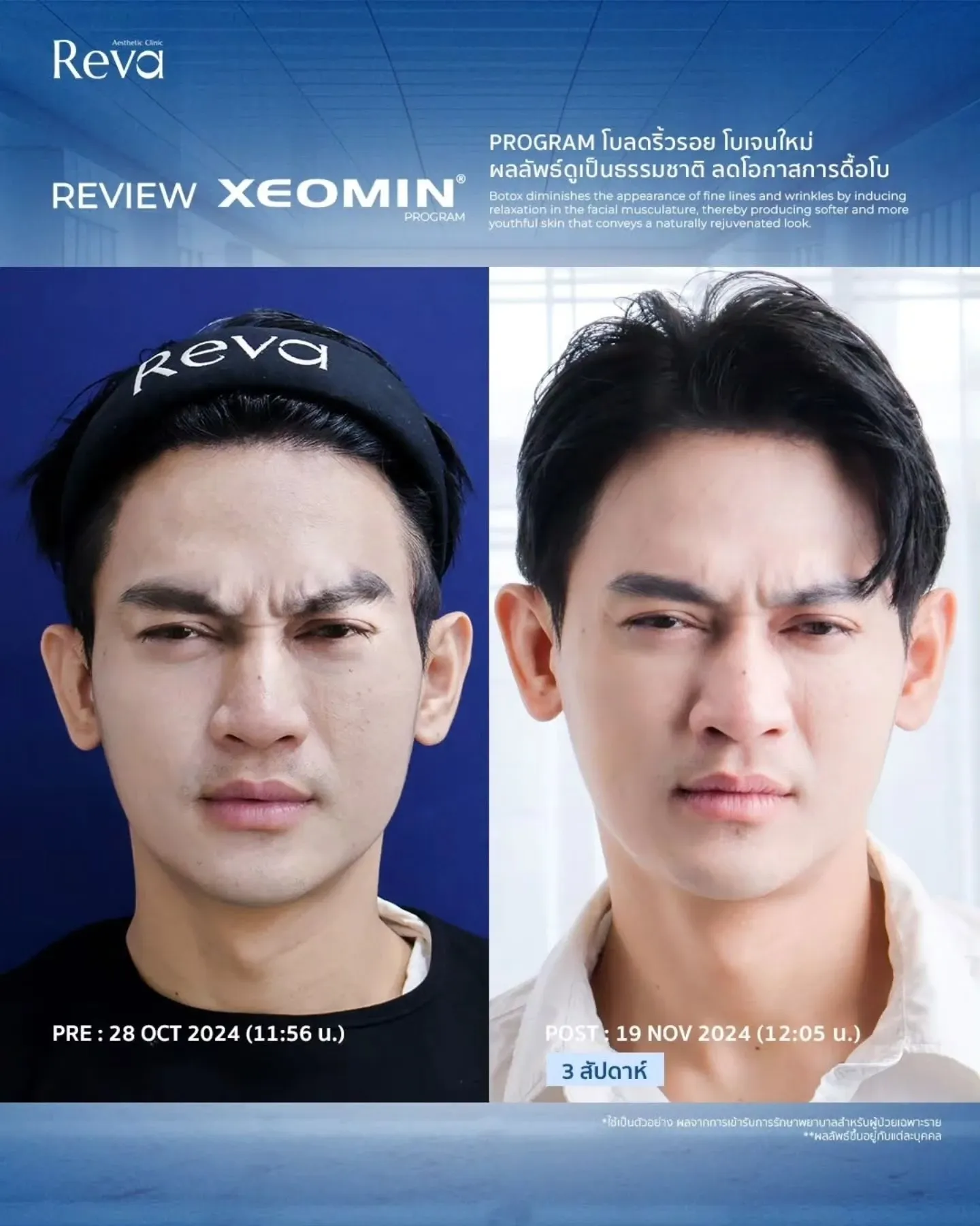 xeomin review