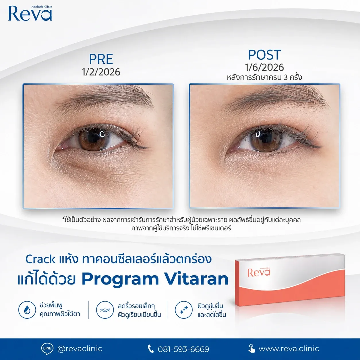 vitaran ช่วยเรื่องริ้วรอยเล็ก ๆ ใต้ตา