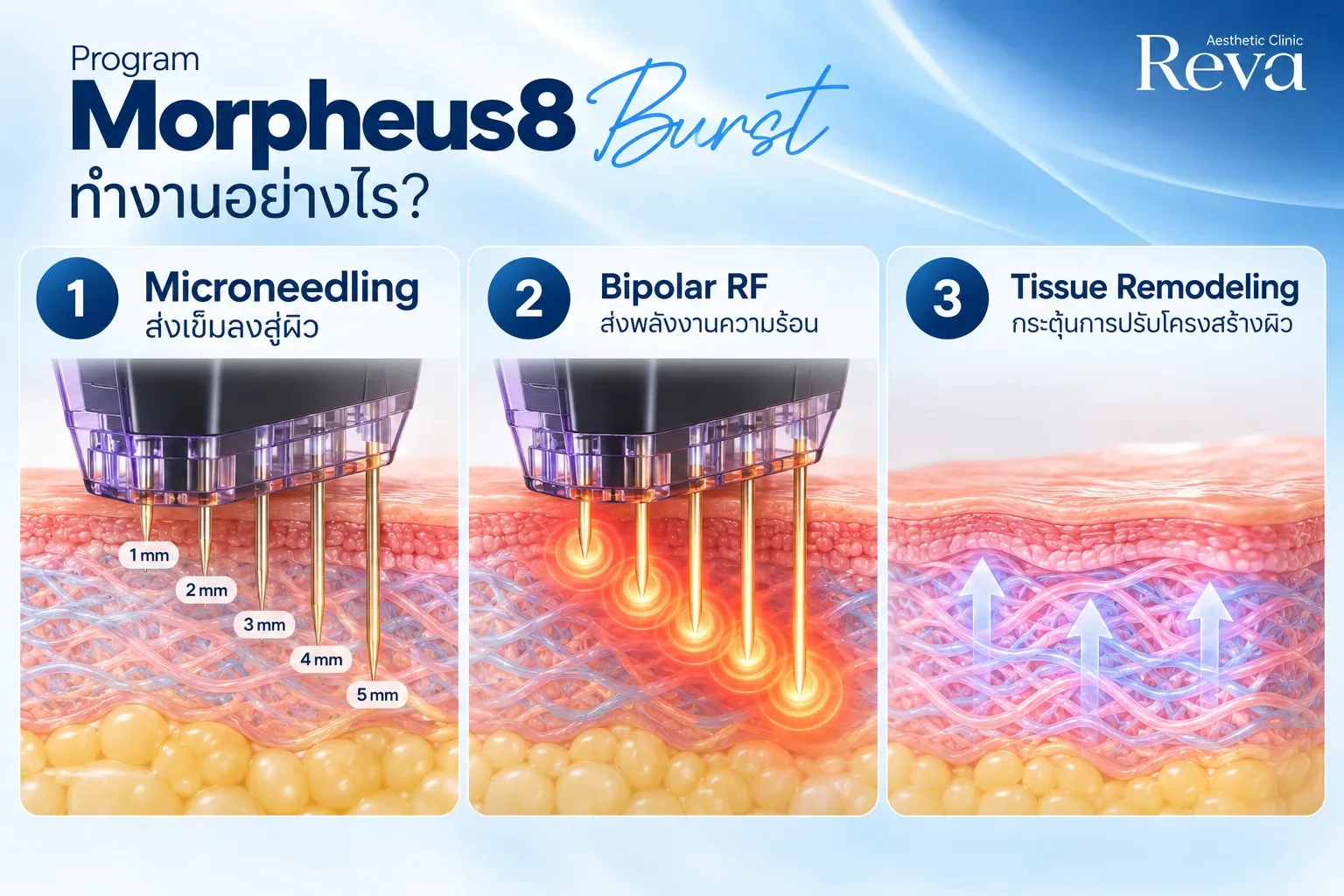 กลไกทำงาน Morpheus8 burst