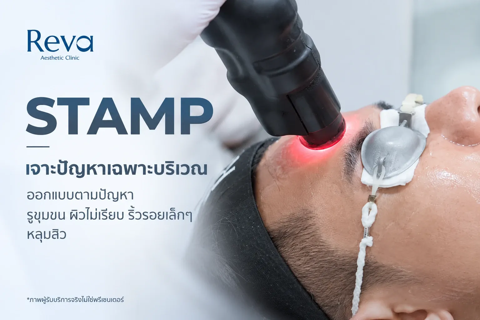 เทคนิค STAMP ของโปรแกรม RedTouch Pro ที่ Reva Clinic สำหรับดูแลรูขุมขน ผิวไม่เรียบ ริ้วรอยเล็กๆ และหลุมสิวแบบเฉพาะบริเวณ