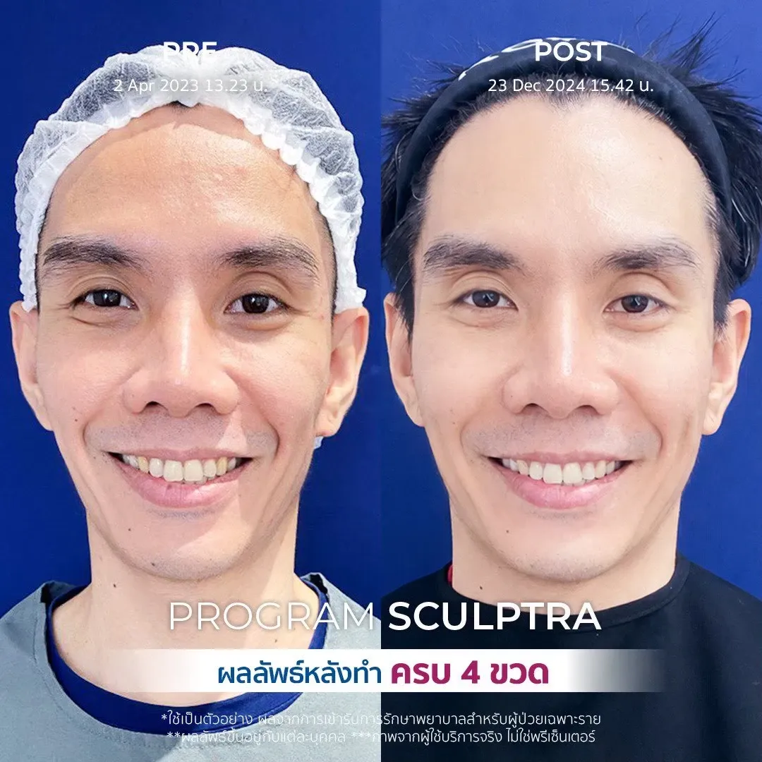 รีวิวรักษาร่องข้างแก้ม