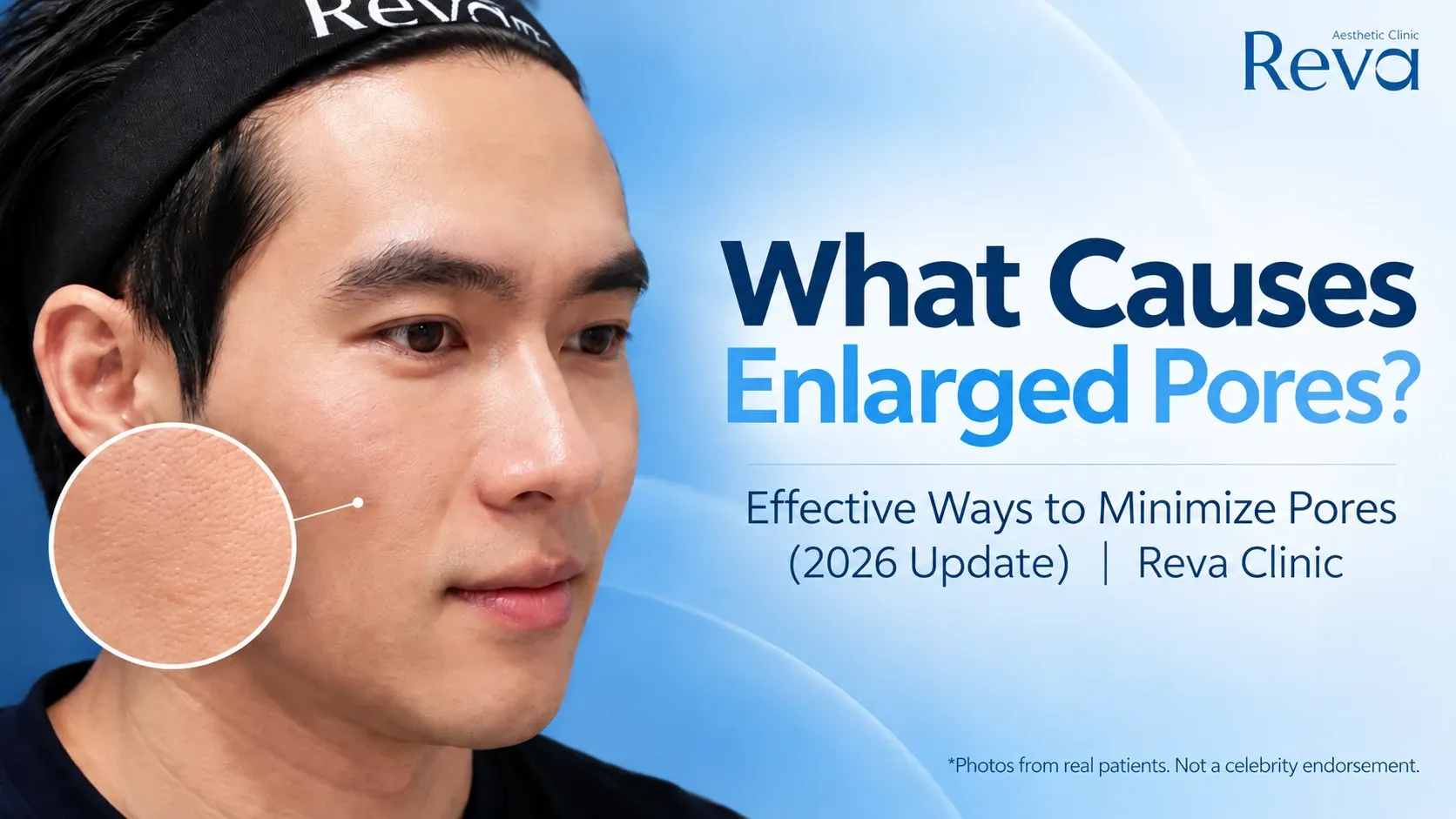 Enlarged Pores 2026