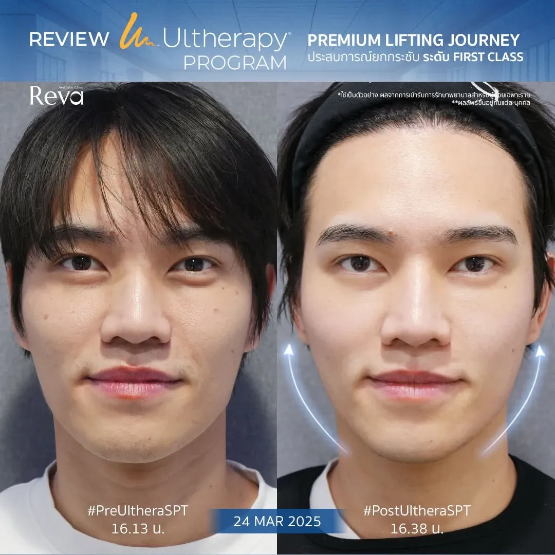ภาพเปรียบเทียบก่อนและหลังทำ Program Ulthera SPT ที่ Reva Clinic บริเวณใบหน้าและกรอบหน้า