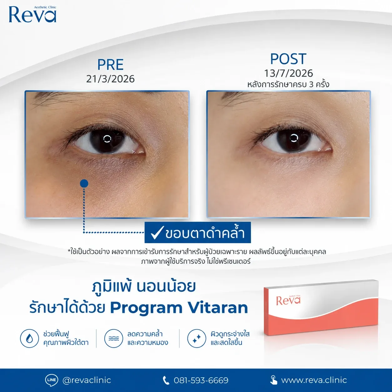 Vitaran ช่วยใต้ตาคล้ำ