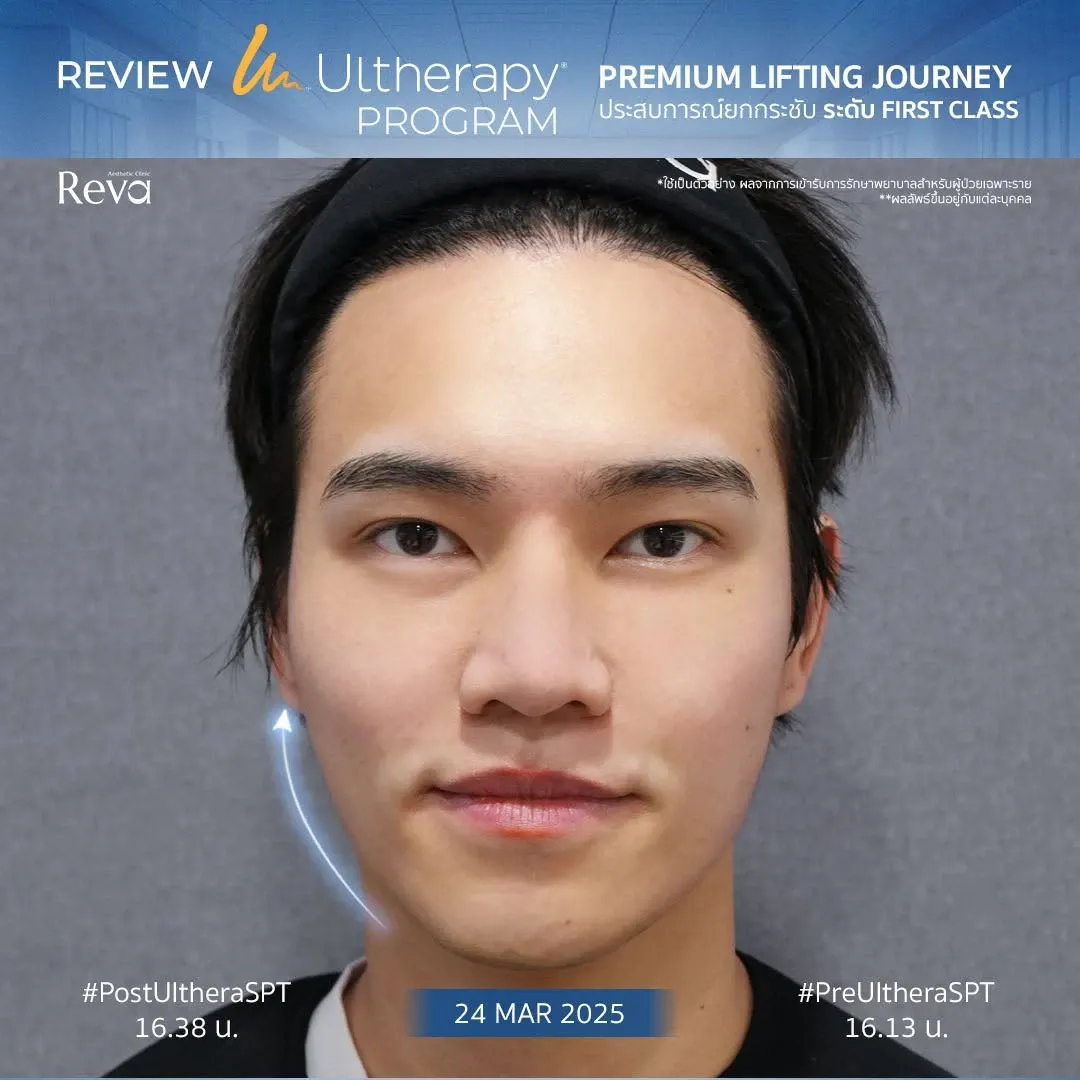 ผลลัพธ์ผู้รับบริการจริง Program Ulthera SPT ที่ Reva Clinic มุมหน้าตรง แสดงการเปลี่ยนแปลงของกรอบหน้า