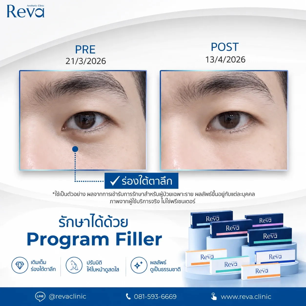 รีวิวฟิลเลอร์ใต้ตา