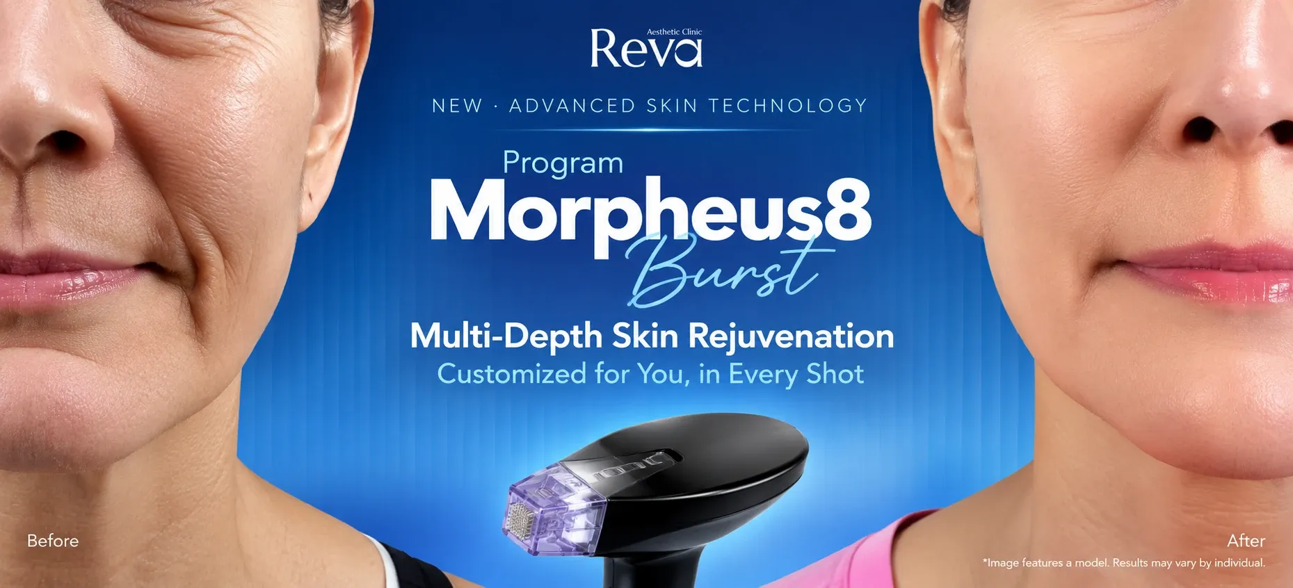 Program Morpheus8 Burst at REVA Clinic