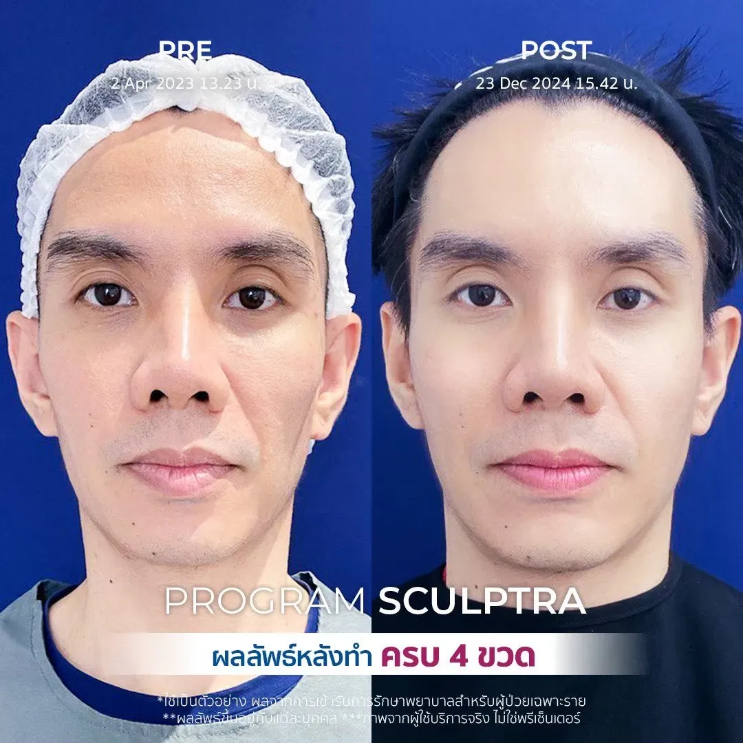 รีวิวรักษาร่องข้างแก้ม