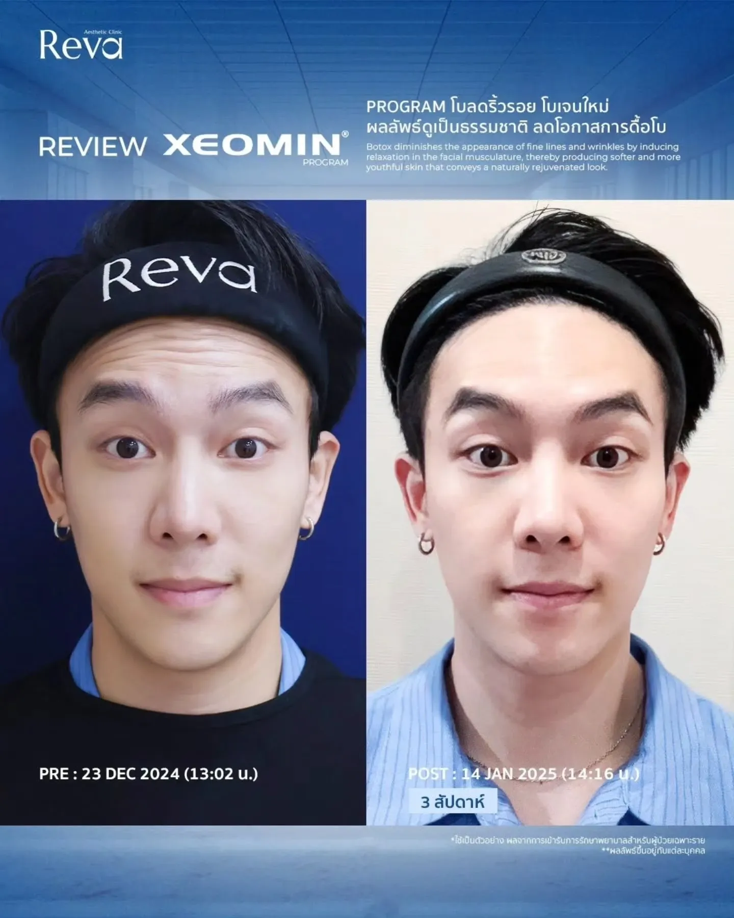 xeomin review