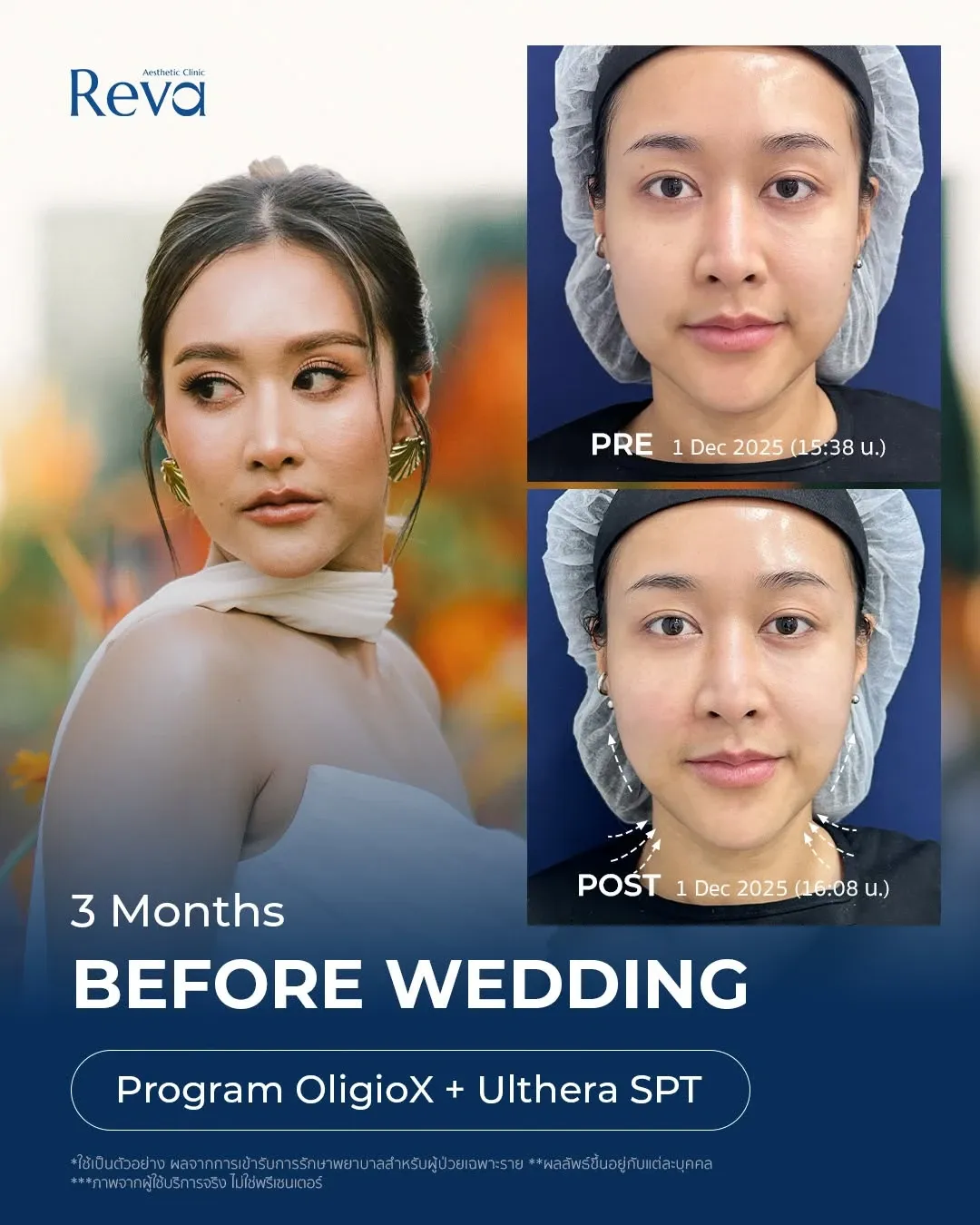 3–6 เดือนก่อนแต่งงาน
