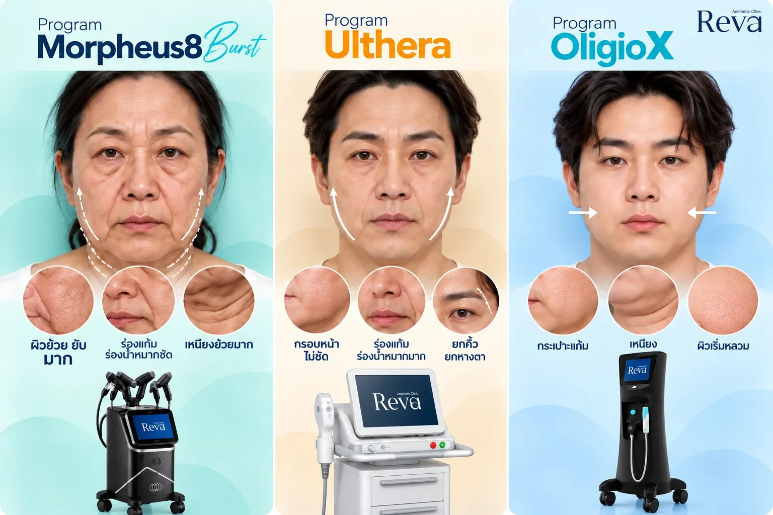 เปรียบเทียบ Morpheus vs Ulthera vs Oligiox