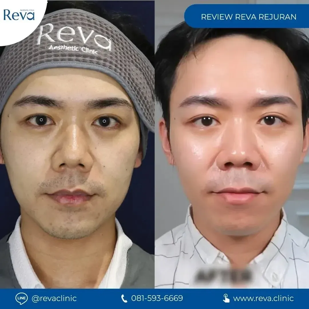 Before-and-after clinical photos showing smoother skin and reduced fine wrinkles after Polynucleotide (PN) treatment.