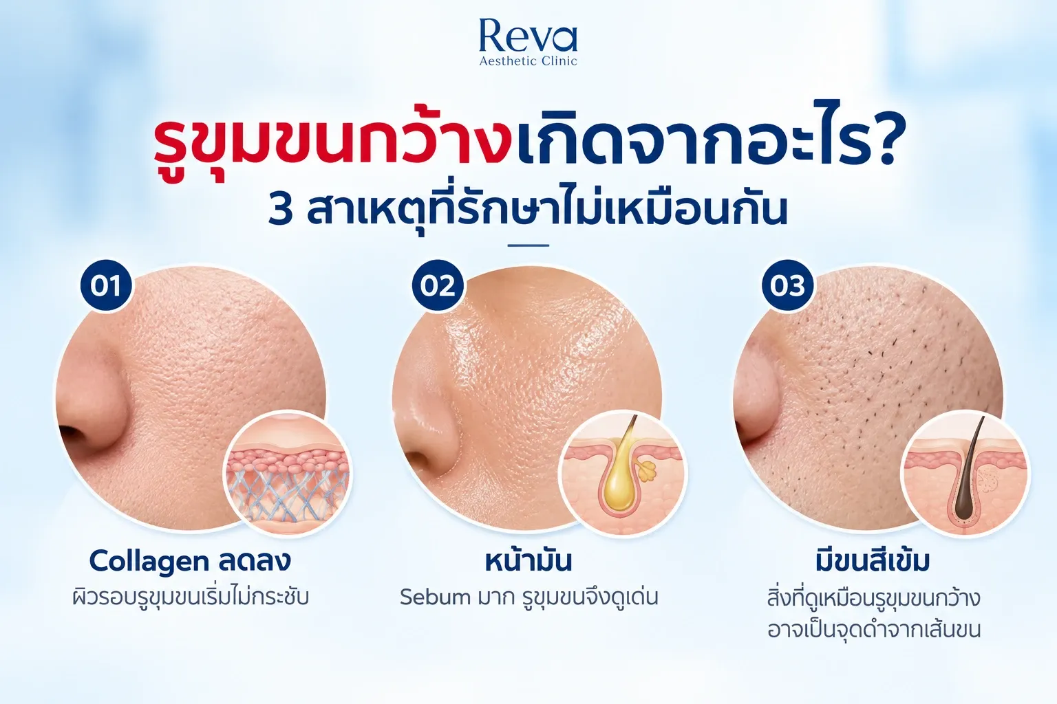 สาเหตุของรูขุมขนกว้าง