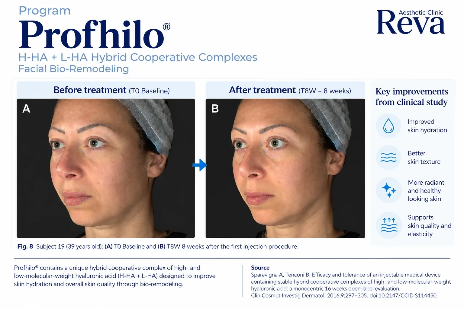 รีวิว Profhilo รักษาร่องข้างแก้ม