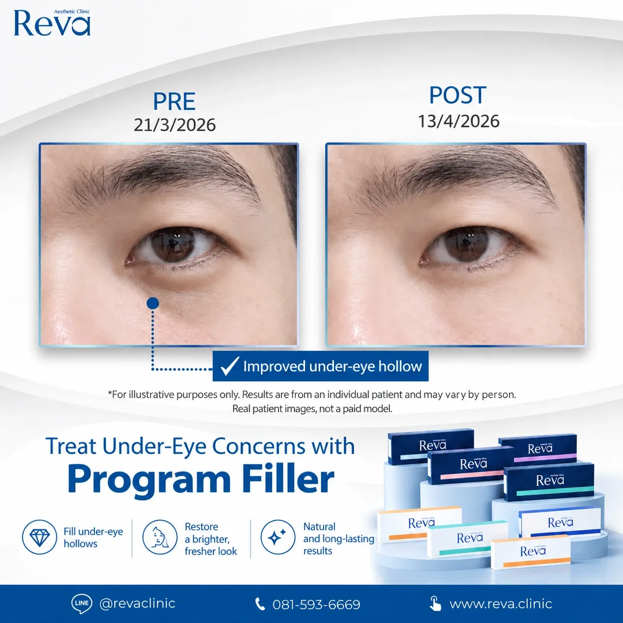review under eye filler