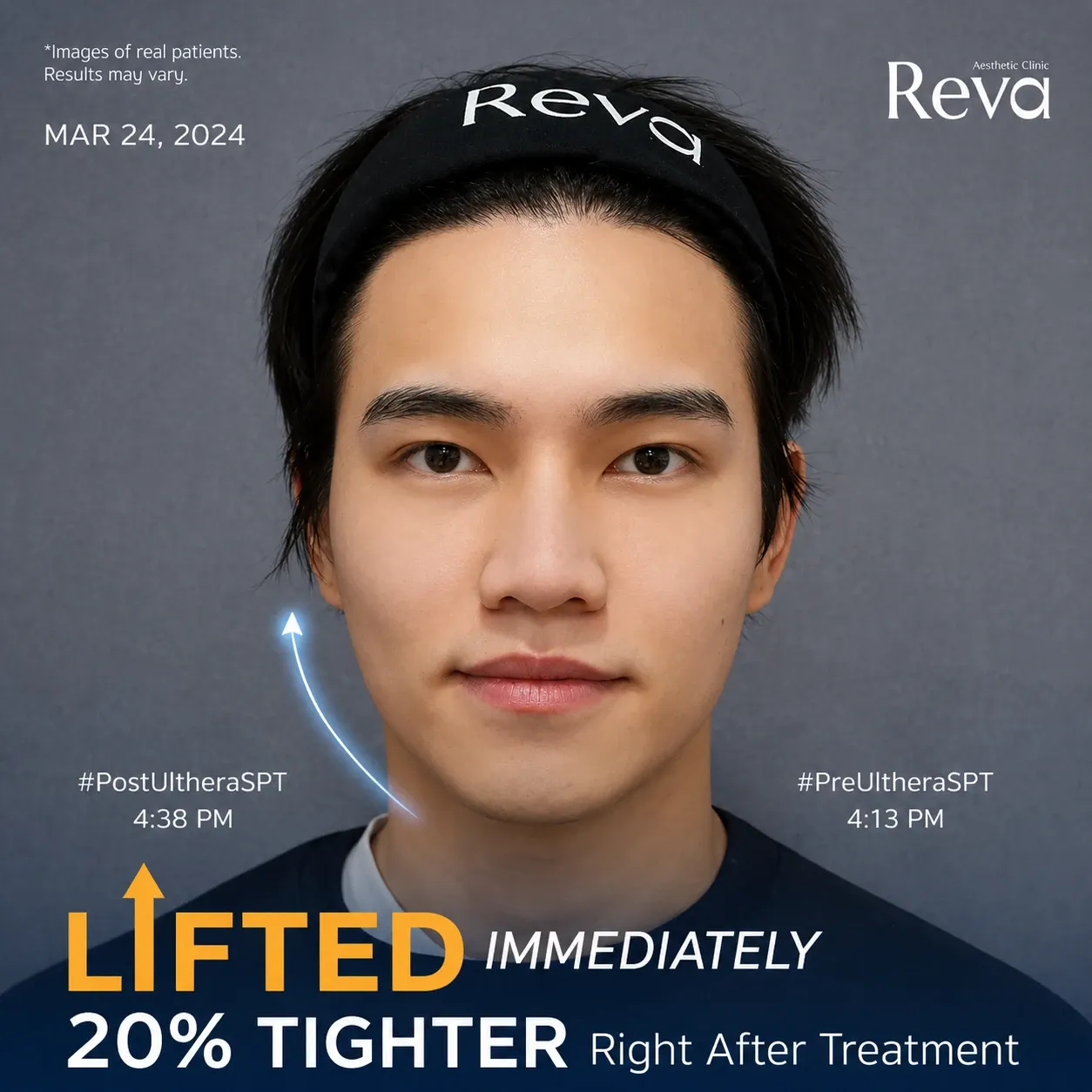 Immediate lifting result after the Ultherapy Program at Reva Aesthetic Clinic.  Caption: Ultherapy Program — visible lifting immediately after treatme