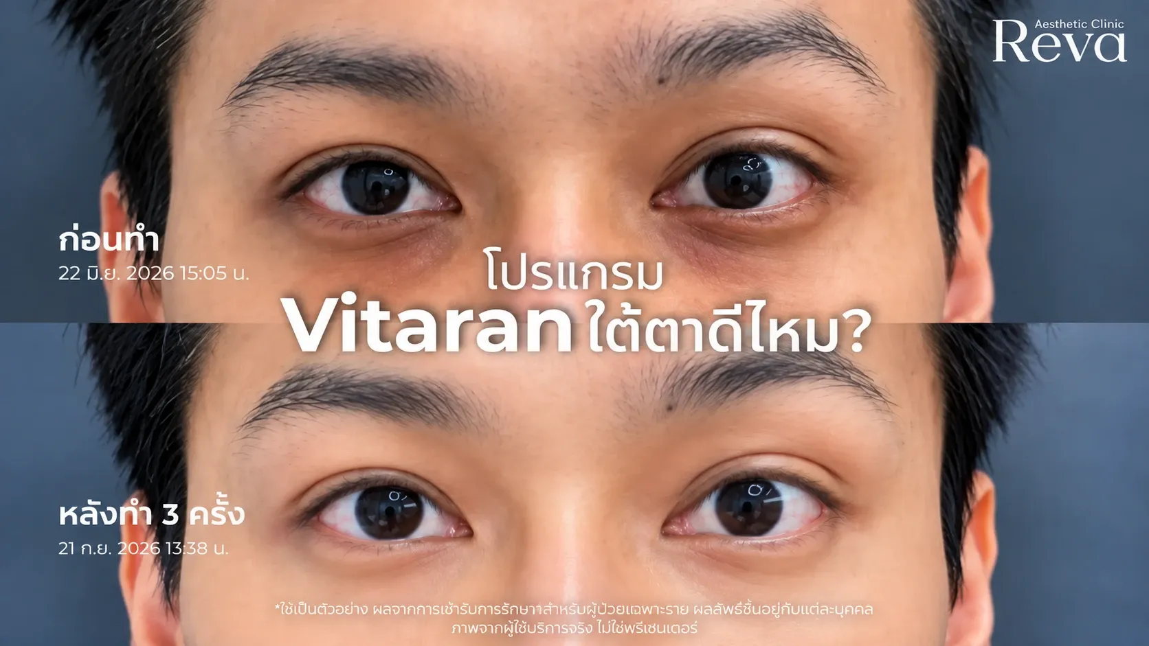 vitaran ใต้ตา